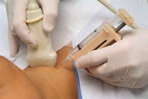 Тонкоигольная аспирационная биопсия