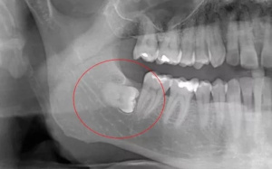 Зубы мудрости — это третьи моляры, последние зубы в ряду, которые прорезаются обычно в возрасте от 17 до 25 лет